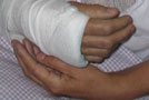 Cvičenie po zlomenine zápästia - začiatočníci
